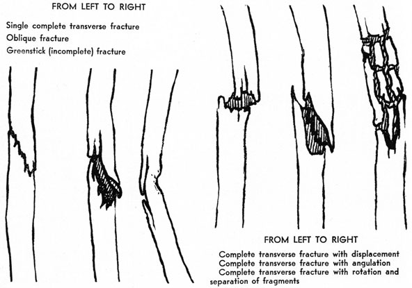 From left to right
Single complete transverse fracture
Oblique fracture
Greenstick (incomplete) fracture

From left to right
Complete transverse fracture with displacement
Complete transverse fracture with angulation
Complete transverse fracture with rotation and separation of fragments