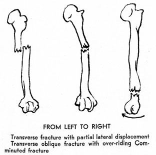 From left to right
Transverse fracture with partial lateral displacement
Transverse oblique fracture with over-riding Comminuted fracture
