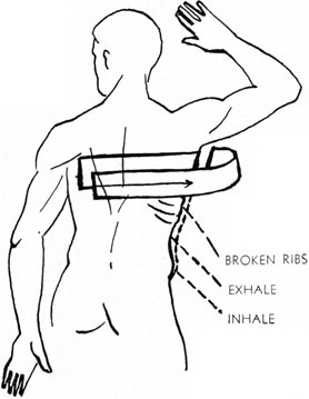 METHOD OF STRAPPING CHEST FOR A FRACTURE OF THE RIB