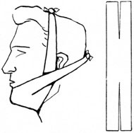 FOUR-TAILED BANDAGE USED IN THE FIRST AID TREATMENT OF FRACTURES OF THE MANDIBLE